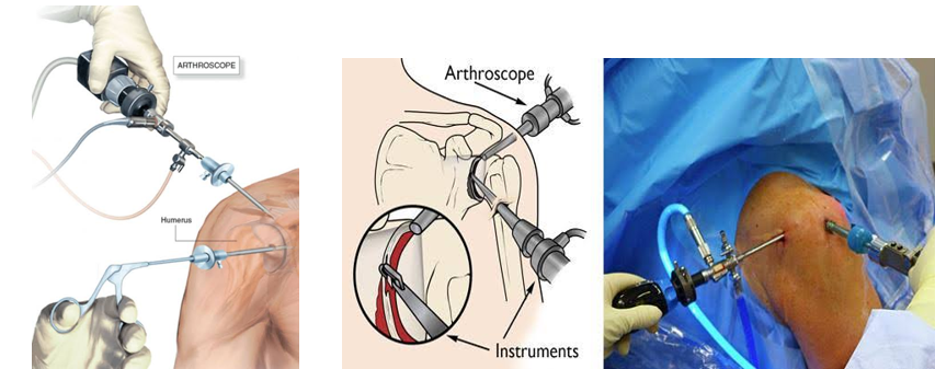 Shoulder Arthroscopy