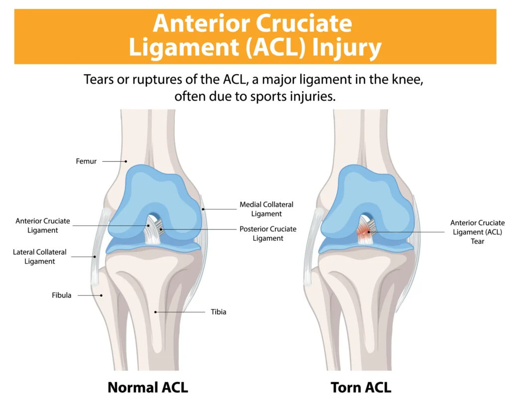 ACL avulsion and arthroscopic knee care