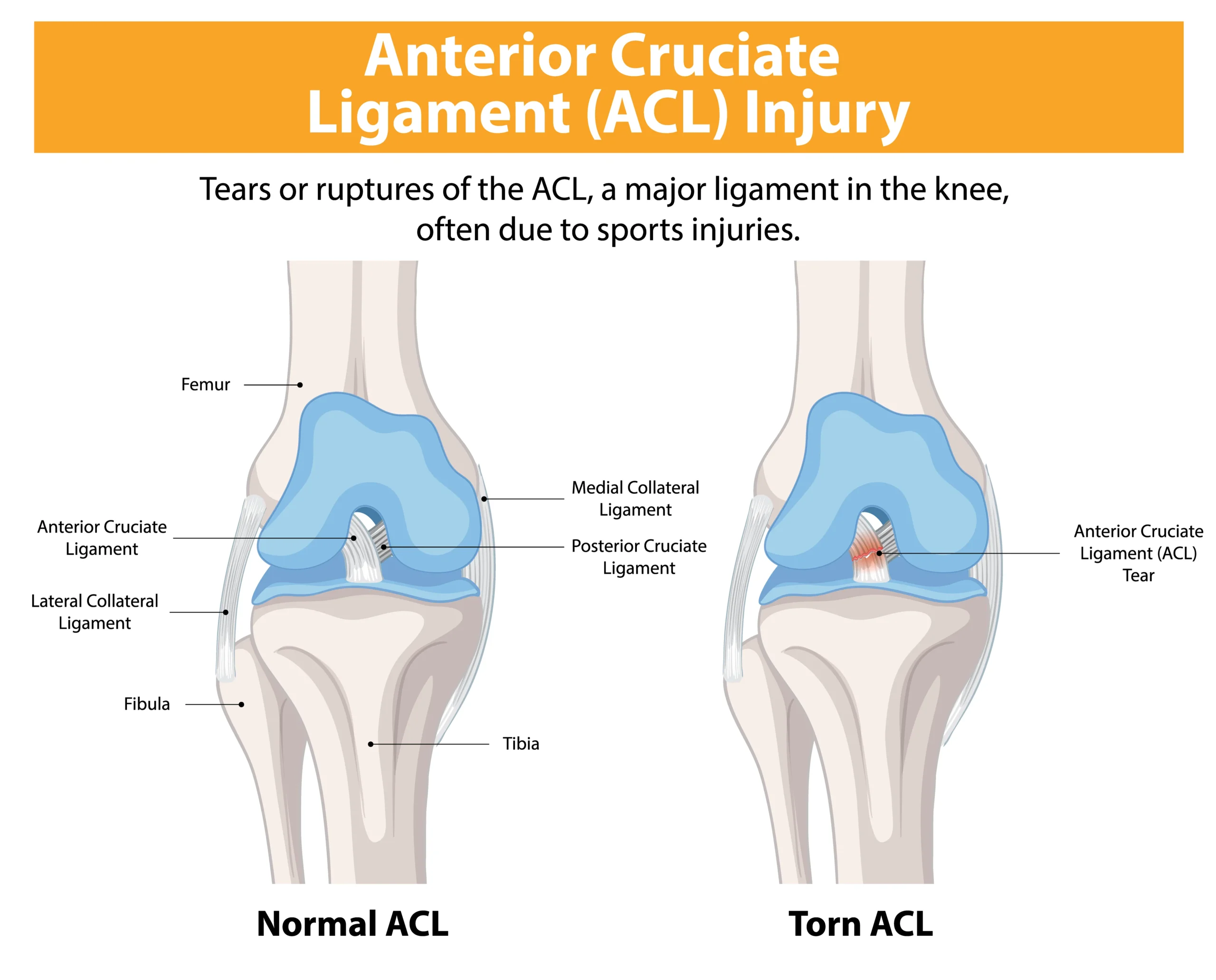 acl-surgery-in-Kota-scaled